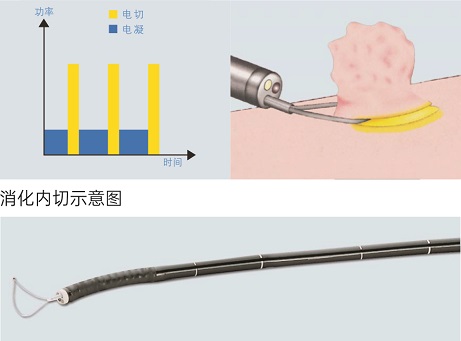 消化内切示意图